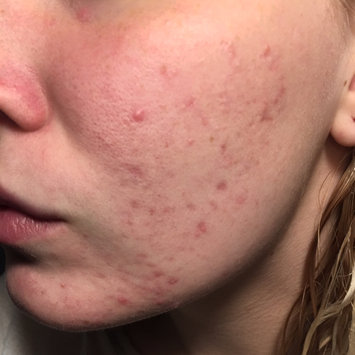 Photo of Bioré Charcoal Acne Clearing Cleanser uploaded by Erin H.