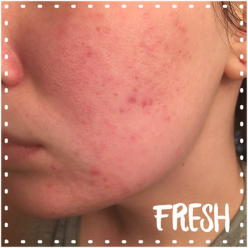 Photo of Bioré Charcoal Acne Clearing Cleanser uploaded by Erin H.