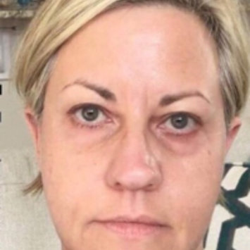 Photo uploaded to Dr. Brandt® Skincare No More Baggage Eye De-Puffing Gel by Chelsea S.