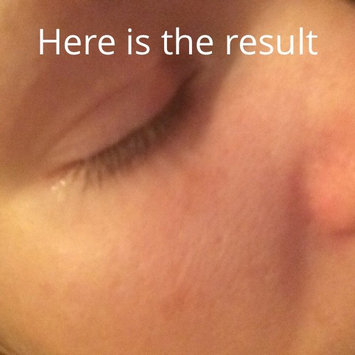 Photo of Murad Post-Acne Spot Lightening Gel uploaded by Hillary M.