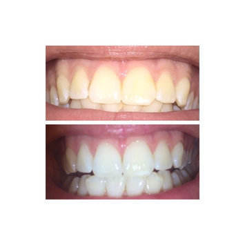 Photo of Crest 3D White Whitestrips 1-hour Express Teeth Whitening Kit uploaded by Lola C.