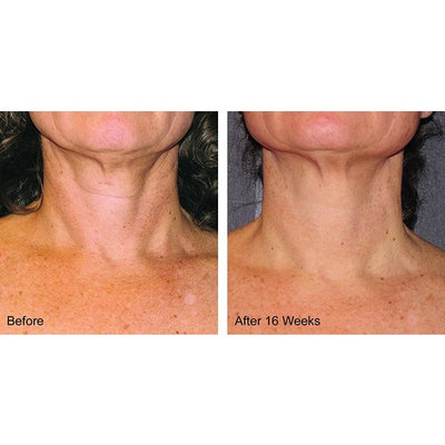 ly Launched Best Ever Neck Reserve Creme - Amazing Results Improvement Can Be Seen Within 3-5 Days! Gaurantee