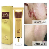 Acne Scar Removal Cream,Skin Repair Face Whitening Gel Cream for Spots Marks Acne Spots Scar Blackhead Stretch Marks 30g